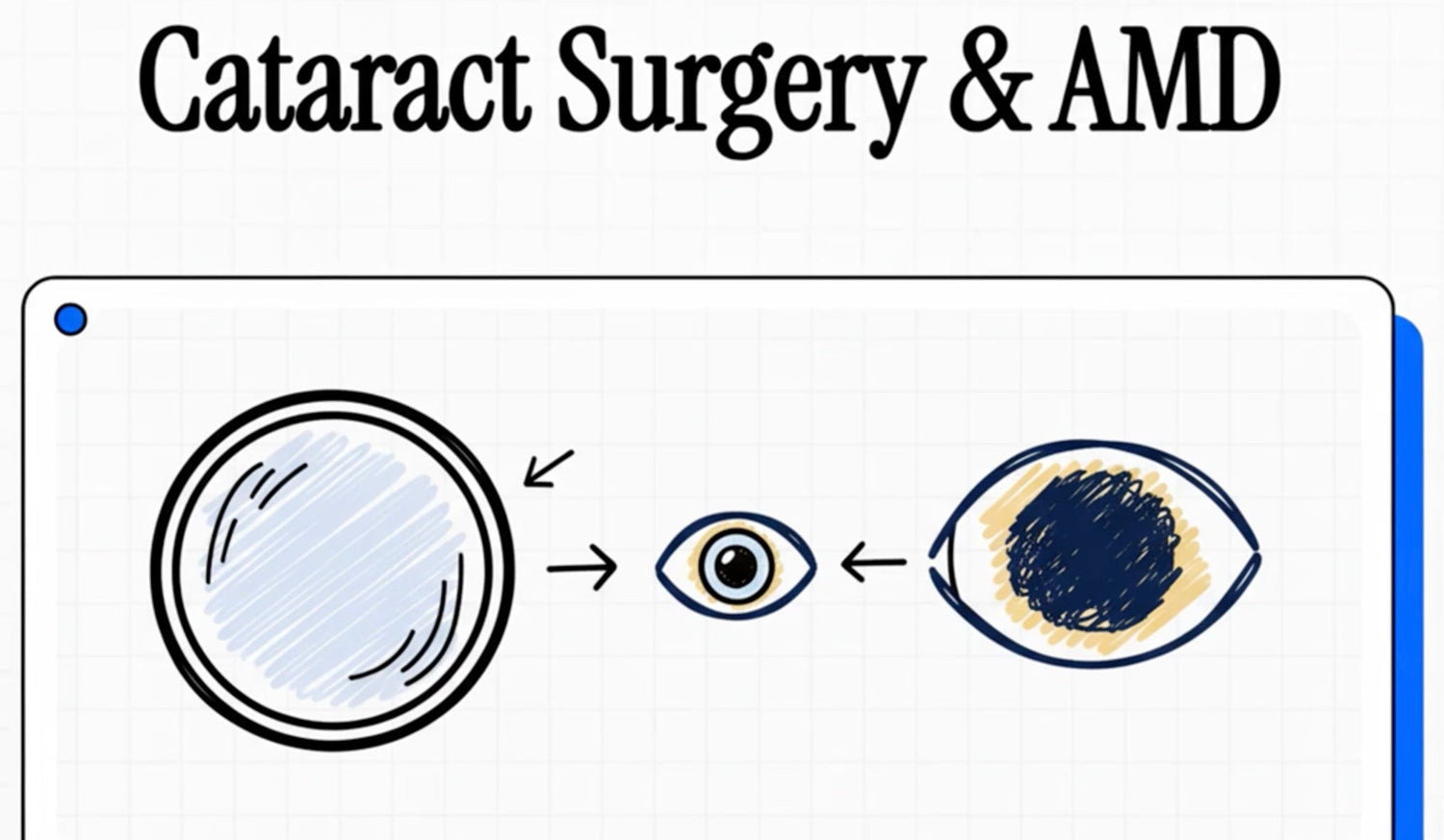 Management of Patients with Co-existing Cataract and Age-Related Macular Degeneration (AMD)